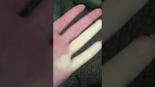 Raynauds disease overview [upl. by Yarised964]