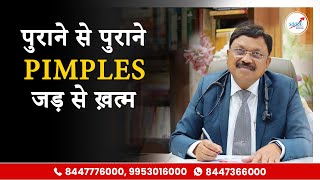 मुँहासे खत्म करने का रामबाण इलाज  How To Remove Pimples Overnight  Acne Treatment amp Medicines [upl. by Galateah90]