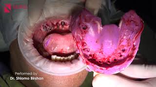 Mono Implants  Full Case  Performed by Dr Shlomo Birshan [upl. by Cenac]