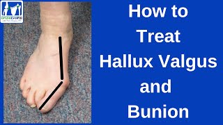 How to Treat Hallux Valgus and Bunion [upl. by Natanoj735]