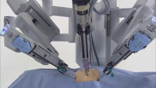 da Vinci® Robotic Surgical System [upl. by Yblehs185]