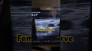 USG guided femoral nerve block femoralnerve anaesthesia usg [upl. by Edric]