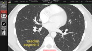 Lobar and Segmental Lung Anatomy on CT [upl. by Leinahtan8]