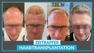 Zeitraffer nach Haartransplantation 1 – 3 – 6 – 9 – 12 Monate Wachstumsverlauf [upl. by Poucher]