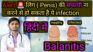 टोपी में संक्रमण  BALANITIS  खुजली दर्द जलन  balanitis treatment home remedies in hindi [upl. by Ardeen458]