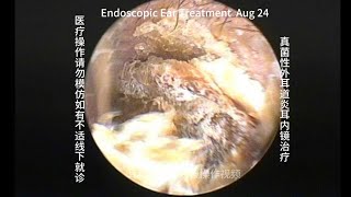 Endoscopic treatment of fungal otitis externa [upl. by Arihsay]