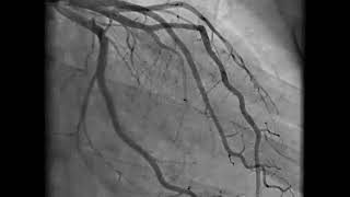 Coronary Angiography  NEJM [upl. by Jaella]