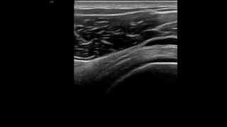 Subacromialsubdeltoid bursa ultrasound [upl. by Shipp432]