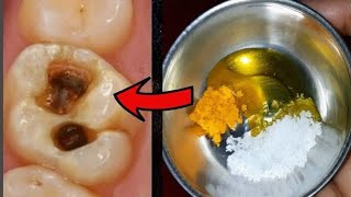 ಭಯಂಕರವಾದ ಹಲ್ಲು ನೋವೇ 5 ನಿಮಿಷದಲ್ಲಿ ಪರಿಹಾರ  Teeth Pain Relief Home Remedy in Kannada [upl. by Gnouv]