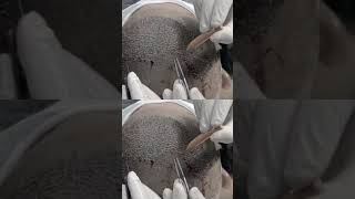 Bio FUE  Hair Transplant Treatment At  Advance Hair India hairrestorationexperts [upl. by Esinert]