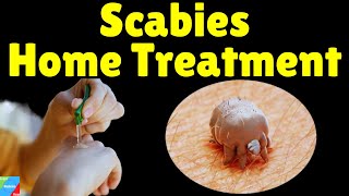 Scabies Home Treatment  Home Remedies for Scabies to Speed Up Treatment  How to Treat Scabies [upl. by Etnod]