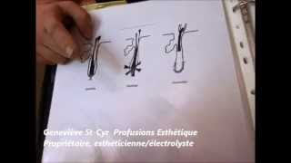 électrolyse epilation par la thermolyse explication [upl. by Ereynihc597]