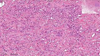 Lobular Carcinoma Breast  Histopathology [upl. by Latoyia]