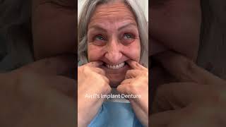 Implant Denture Removal amp Placement [upl. by Rivalee703]