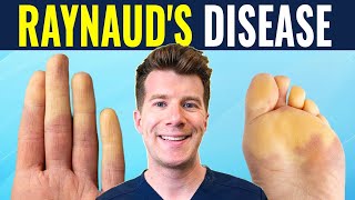 Doctor explains Raynauds disease and syndrome  Causes prevention and treatment [upl. by Eiznik475]