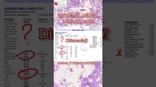 Leucemia aguda medicina hematologia [upl. by Joel899]