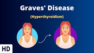 Graves Disease Everything You Need To Know [upl. by Calondra]