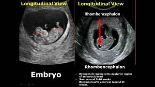 First Trimester amp Ectopic Pregnancy Ultrasound Image Appearances [upl. by Kristen668]