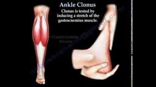 Ankle Clonus  Everything You Need To Know  Dr Nabil Ebraheim [upl. by Sanalda429]