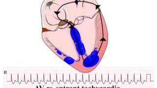 ECG Bài 33 AVRT Điện Tim Điện Tâm Đồ [upl. by Rosenblum540]