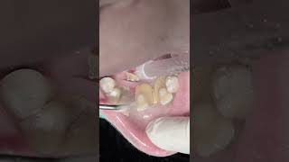 scaling calculus and tartar then replace with porcelain bridge dentist satisfying [upl. by Niltac]