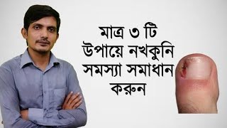 ১দিনে নখের কুনি পাকা ও নখের ব্যাথা দূর করার কার্যকরী উপায  নখের কুনি  নখকুনি সমস্যা দূর করার উপায় [upl. by Yotal]