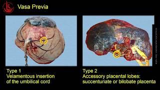 Vasa Previa Ultrasound Diagnosis [upl. by Millan]