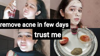 remove acne in few days  special acne face pack  easy pimples remedy [upl. by Fabio640]