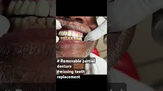 Removable partial denture missing teeth replacement [upl. by Nnaerb]