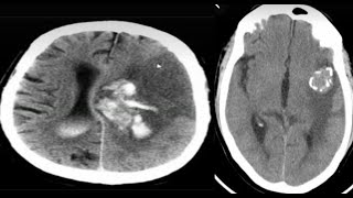 CNSSpotters 16 case Radiology neuroradiology radiological radiopedia frcr medicalimaging [upl. by Aicyla290]