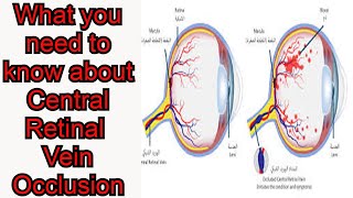 Central Retinal Vein Occlusion CRVO Blurred visionEye pain [upl. by Akayas]