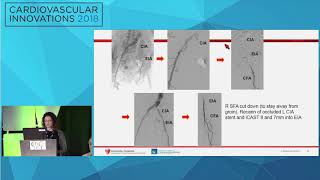 CVI2018 Session Common femoral and aortoiliac disease  hybrid approach  Karem Harth MD [upl. by Morell]