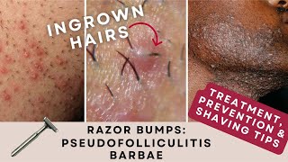 Razor Bumps Pseudofolliculitis Barbae  Prevention amp Treatment [upl. by Lowrie]