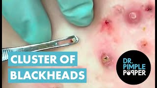 50 Minutes of Blackheads Clusters of Blackheads with Dr Pimple Popper [upl. by Otilesoj]