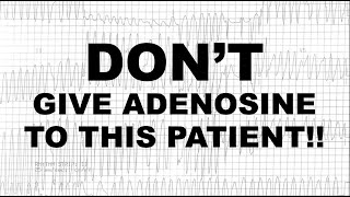 Dont Give Adenosine To This Patient [upl. by Ainadi722]