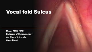 Vocal folds Sulcus [upl. by Ecnarual99]