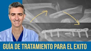 Fracturas de Clavícula Evaluación y Tratamiento para Médicos Generales [upl. by Crow]