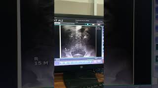 Fluoroscopy  fluoroscopy procedure  ivu procedure ivp procedure viral trending shorts [upl. by Millard]