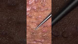 Ingrown Hair Removal Ep15 [upl. by Kalindi283]