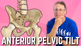 Anterior Pelvic Tilt Do You Have It How to Fix A BIG SURPRISE [upl. by Rimma422]