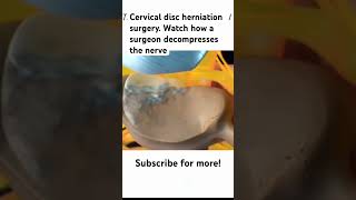 Cervical disc herniation surgery surgeryday herniateddisc neurosurgeon medicine anatomy [upl. by Akihsan872]