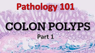 Colon Polyps  Part 1 Pathology 101 [upl. by O'Conner]