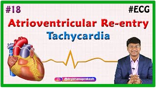 18 Atrioventricular Reentry Tachycardia amp Atrioventricular Nodal Reentrant Tachycardia [upl. by Iba]