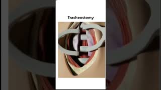 Tracheostomy shorts mbbs femalereproductivesystem pregnancy [upl. by Artkele]