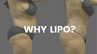 Why LIPOSUCTION  Sono Bello [upl. by Stevana]