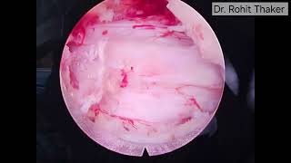 Interlaminar Endoscopic Decompression Lumbar Canal Stenosis L45 Dr Rohit Thaker spine doctor [upl. by Arodnap]