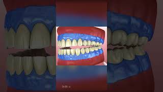 Teeth Whitening Process [upl. by Anabahs]