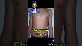 chickenpox rashes how to identify chickenpox shorts child illness papule [upl. by Iren]