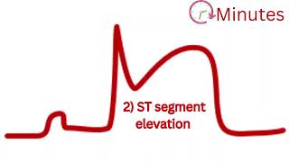 Understanding Myocardial Infarction STEMI ECG Evolution Explained [upl. by Irra]