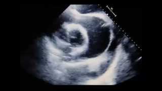 Transthoracic Echocardiogram Showing Pericardial Tamponade [upl. by Anaujal]